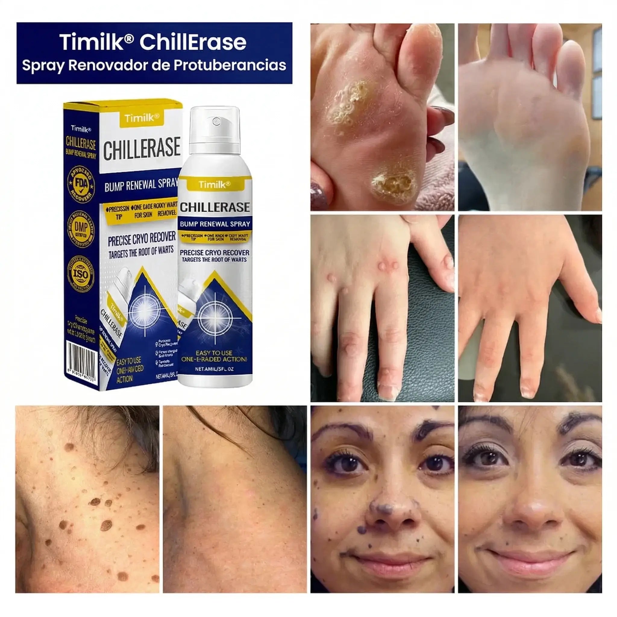 Timilk® ChillErase - Spray quita verrugas